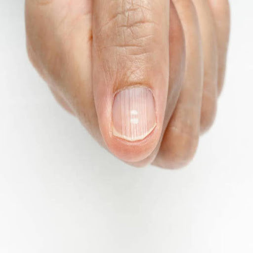 Les ongles striés, c’est quoi ?